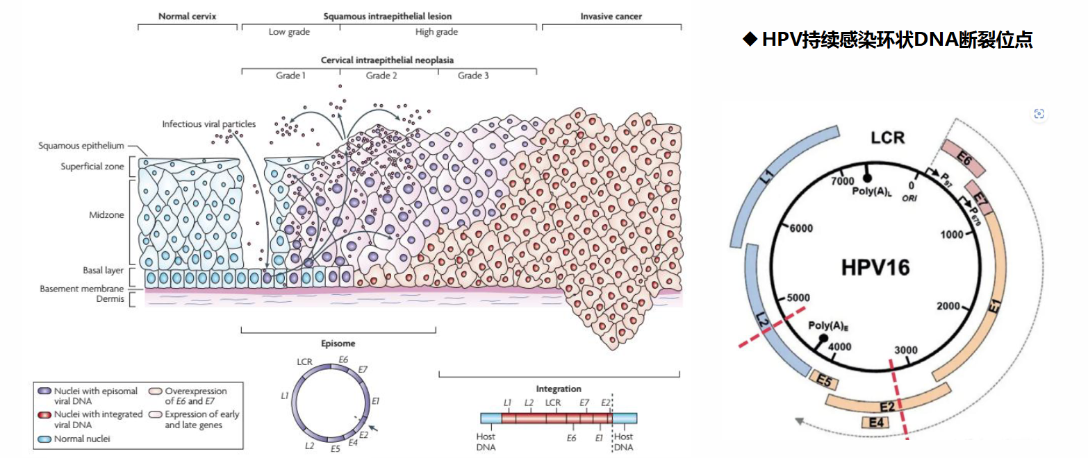 HPV 感染组织病理与 HPV16 DNA 结构示意图